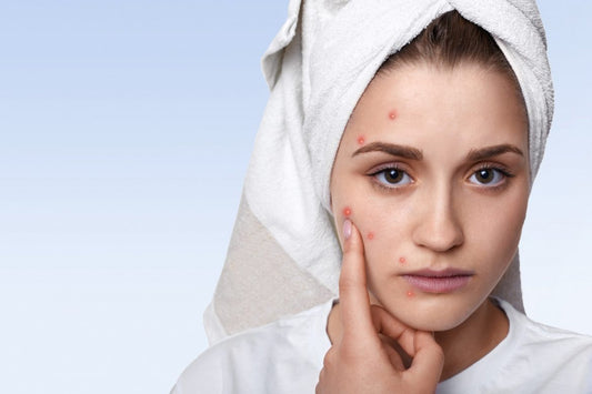 How to Treat Acne and Pimples by Ayurveda?