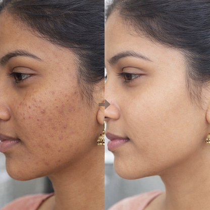 Kasturi Manjal (Musk Turmeric Powder) Skin Brightening & Tan Removal Face Pack for All Skin Type 25Gs